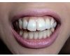★歯フェチ写真★ギャル系デリヘルガールの歯の移り変わり