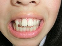 ★歯フェチ写真★18歳清楚●リ系短大生の歯 FT-PROJECT dgpot.com