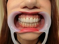 パーフェクトな差し歯お姉さまの歯 FT-PROJECT dgpot.com