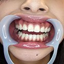 【歯フェチ】ゆあちゃんの美しい歯並びとキラっと光る銀歯を観察！ 口内・噛みつき・歯フェチマスター dgpot.com