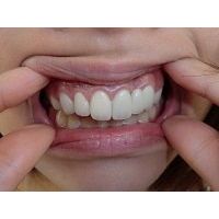 ★歯フェチ写真★23歳差し歯女子の歯