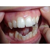 ★歯フェチ写真★25歳モデルさんの歯