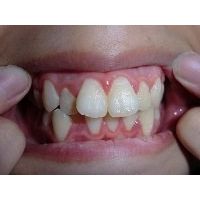 ★歯フェチ写真★18歳専門学校生の歯