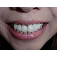 ★歯フェチ写真★総人工歯な美人奥様の歯