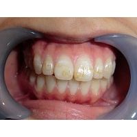 ★歯フェチ写真★歯並びキレイでも、着色が目立つ女の子の歯