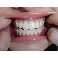 ★歯フェチ写真★20歳黒髪女子大生の歯